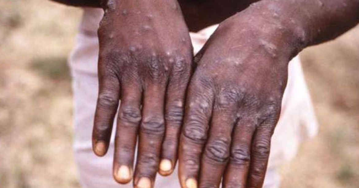 Mpox deaths in Africa surpass 1,000 as health Officials urge Mpox deaths in Africa surpass 1,000 as health Officials urge global support